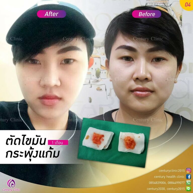 Review ตัดไขมันกระพุ้งแก้ม2-CenturyClinic