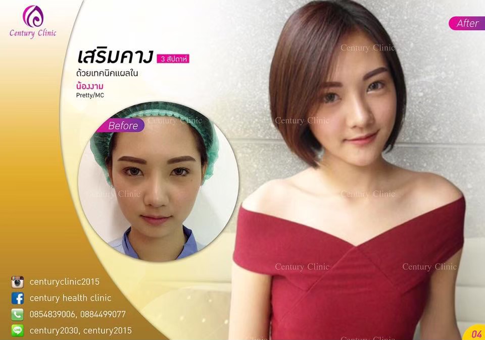 รีวิว เสริมคาง1-Century