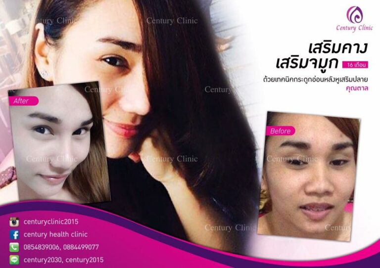 รีวิว เสริมจมูก10-CenturyClinic