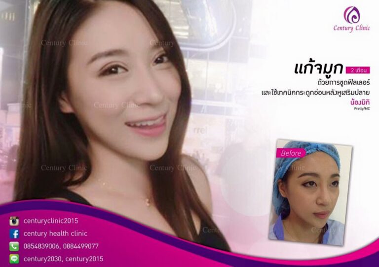 รีวิว เสริมจมูก8-CenturyClinic