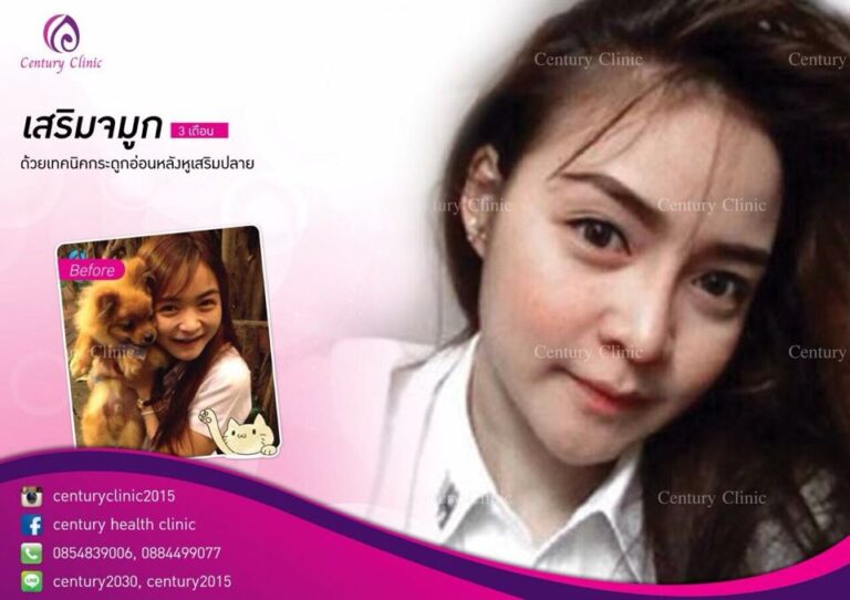 รีวิว เสริมจมูก9-CenturyClinic