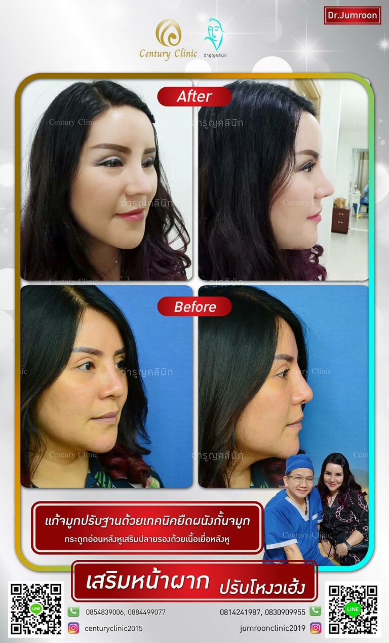 รีวิว เสริมหน้าผาก10-CenturyClinic