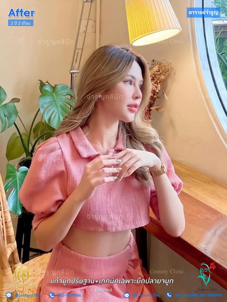 รีวิว แก้จมูก22 CenturyClinic
