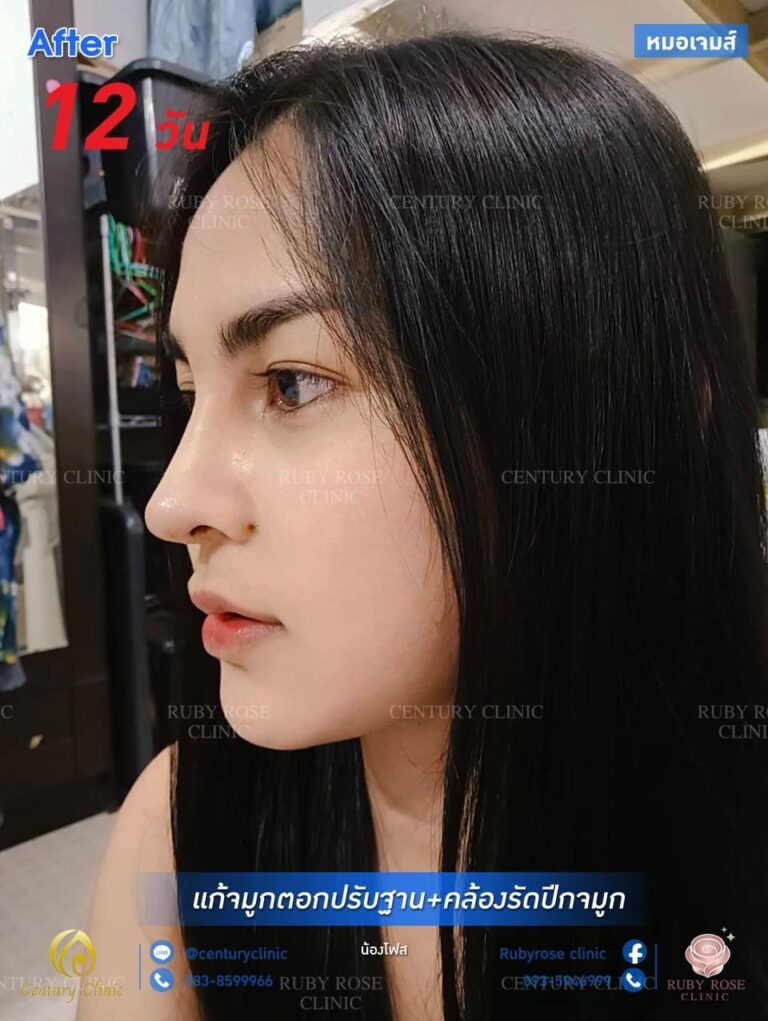 Century รีวิว แก้จมูก #141