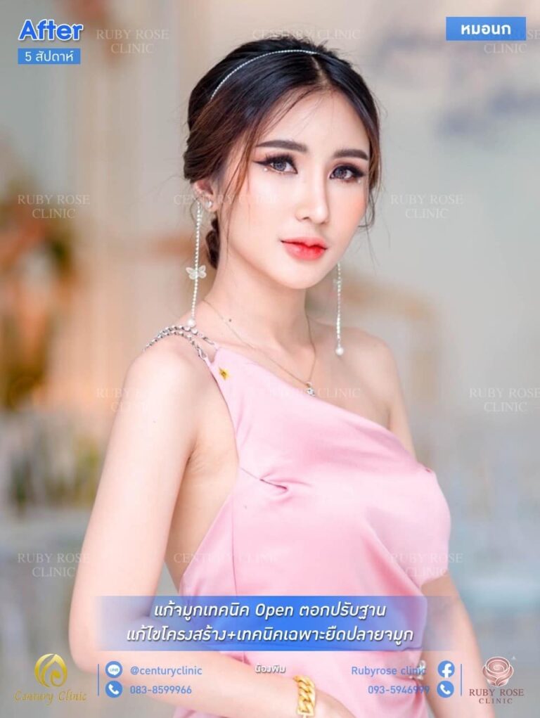 Century รีวิว แก้จมูก #144