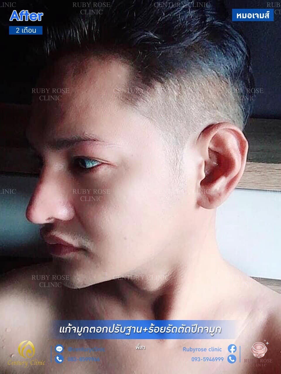Century รีวิว แก้จมูก #148