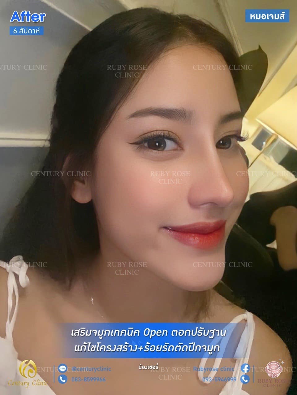 รีวิว เสริมจมูก #109