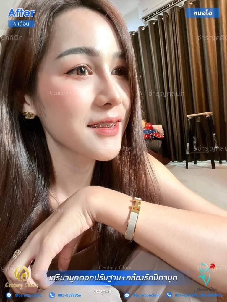 รีวิว เสริมจมูก #134