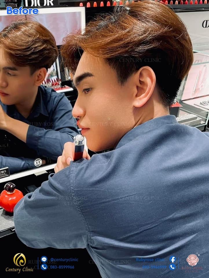 รีวิว เสริมจมูก 1#90