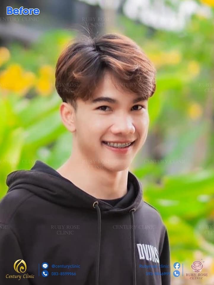 รีวิว เสริมจมูก #57