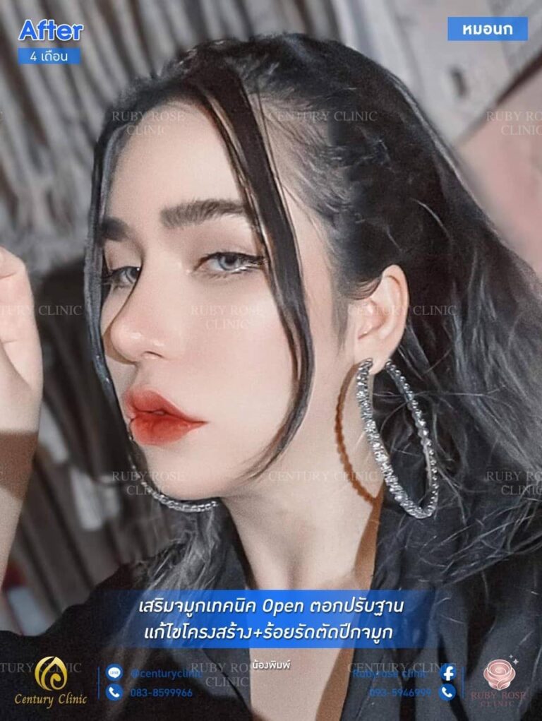 รีวิว เสริมจมูก #83