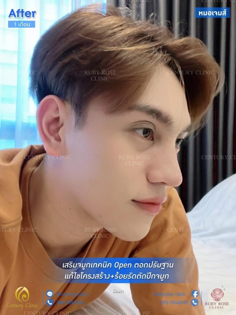 รีวิว เสริมจมูก #90