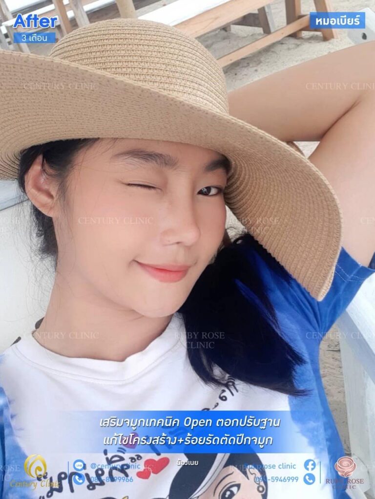 รีวิว เสริมจมูก #95