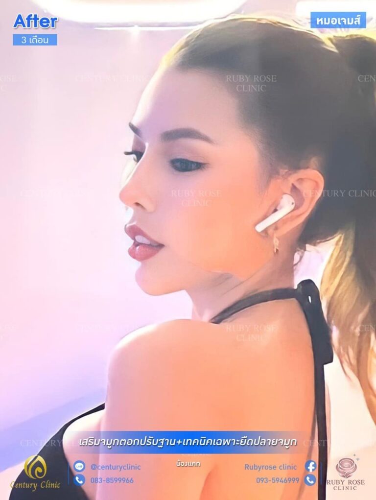 รีวิว เสริมจมูก #97