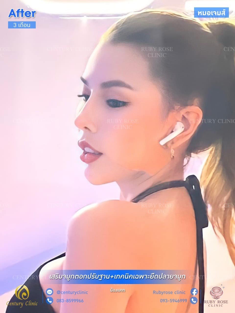 รีวิว เสริมจมูก #97