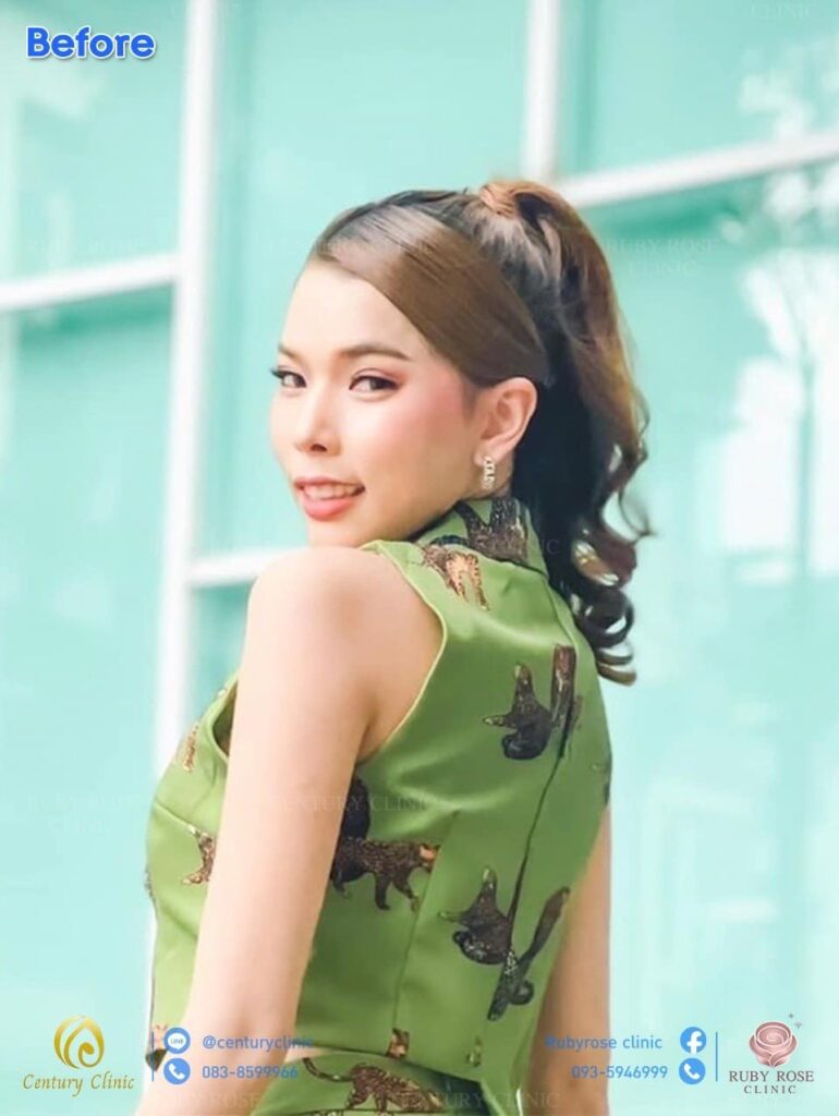 รีวิว เสริมจมูก2 #97