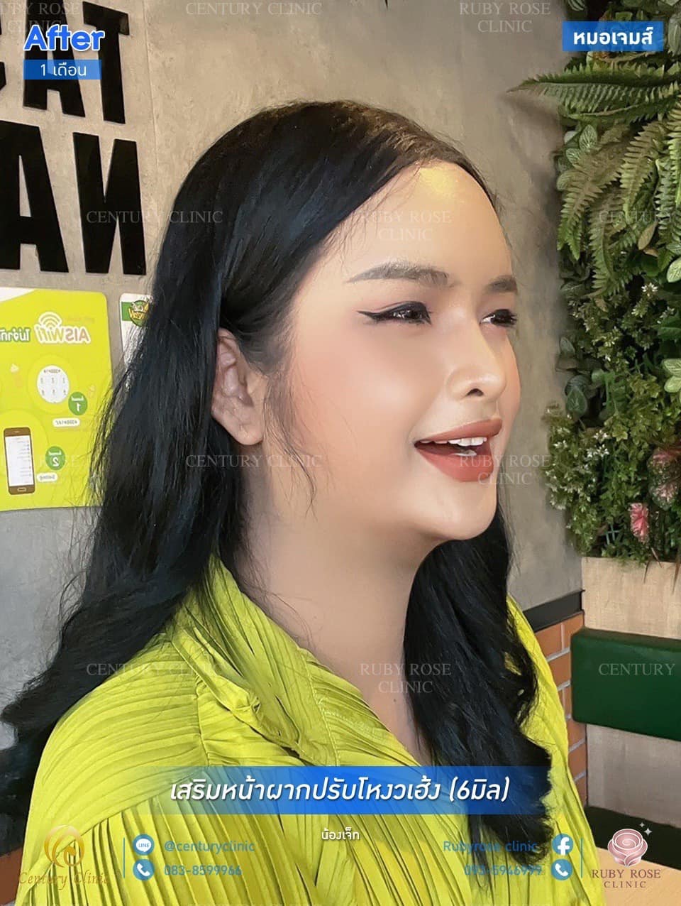 รีวิว เสริมหน้าผากปรับโหงวเฮ้ง #13