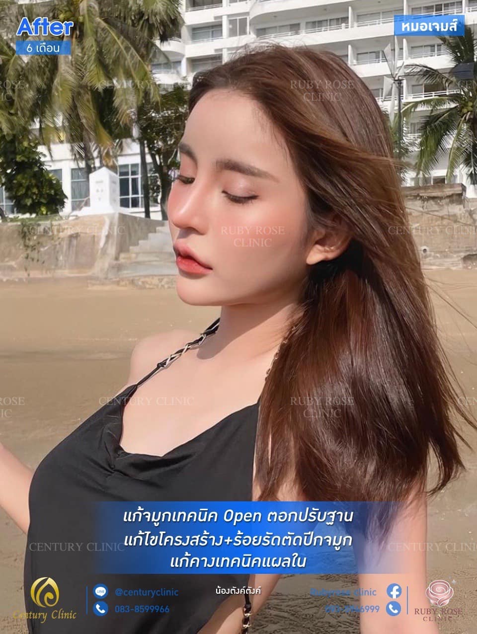 รีวิว แก้จมูก #115 , Century Clinic Thailand รีวิว แก้จมูก #115