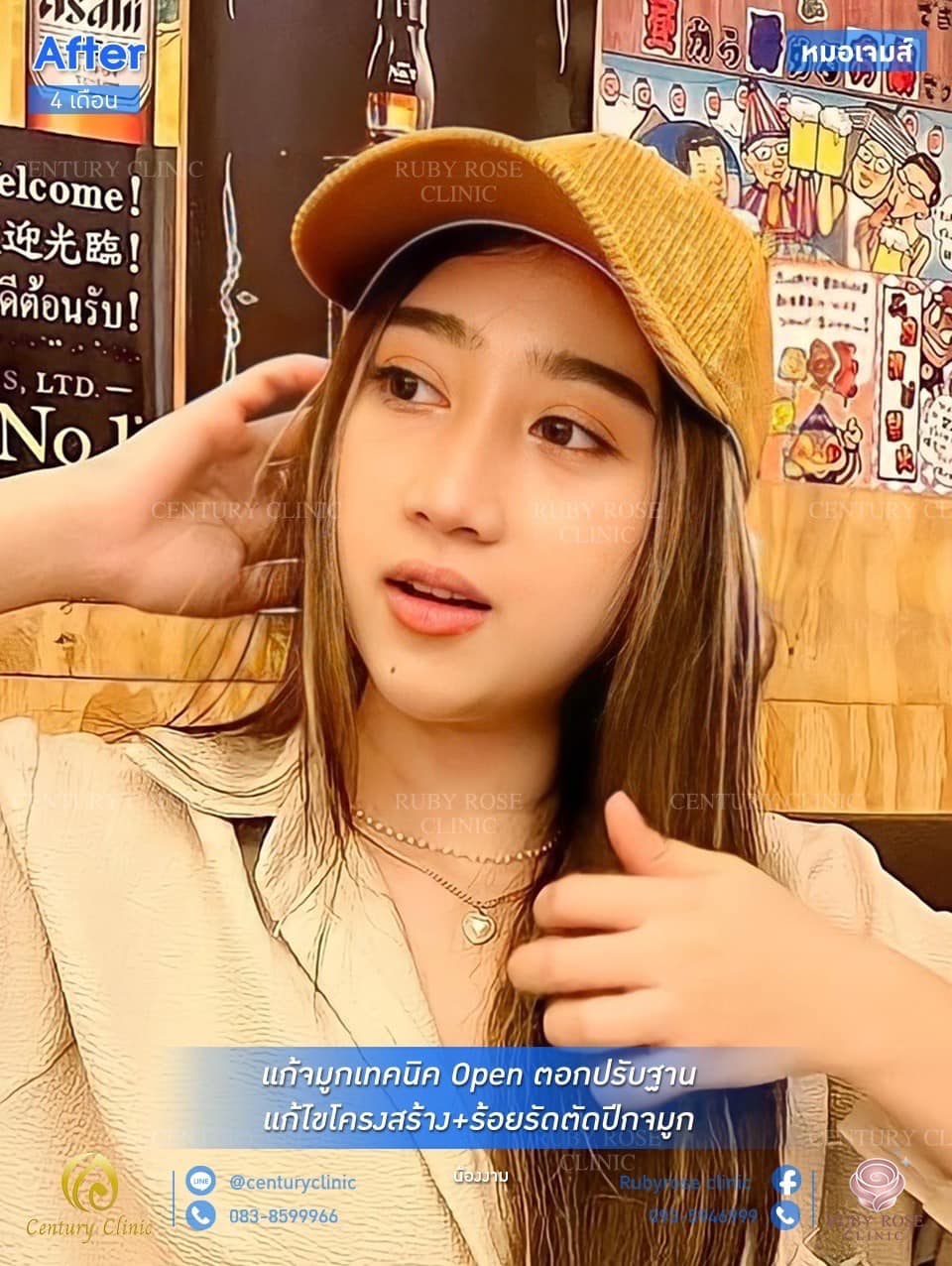 รีวิว แก้จมูก #128
