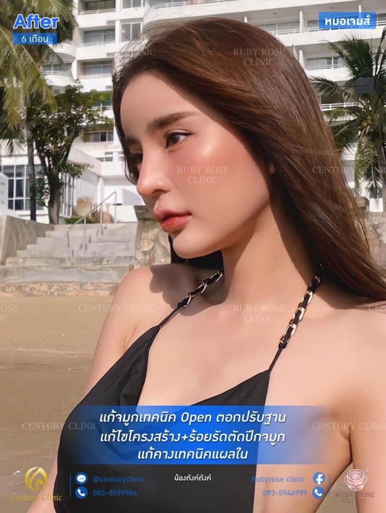 รีวิว แก้จมูก #115 , Century Clinic Thailand รีวิว แก้จมูก 2#115