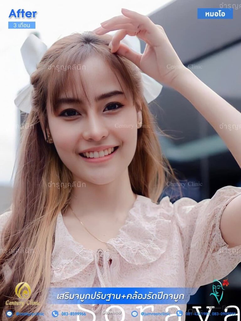 รีวิว แก้จมูก2 #27