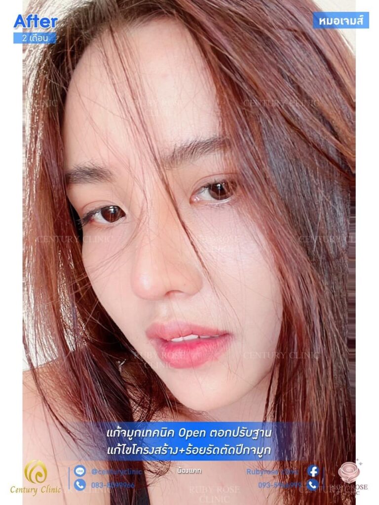 รีวิว แก้จมูก #28