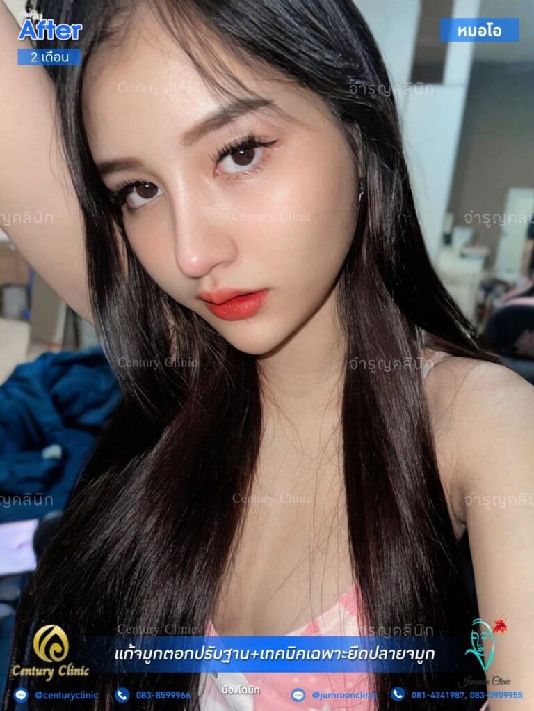 รีวิว แก้จมูก #30