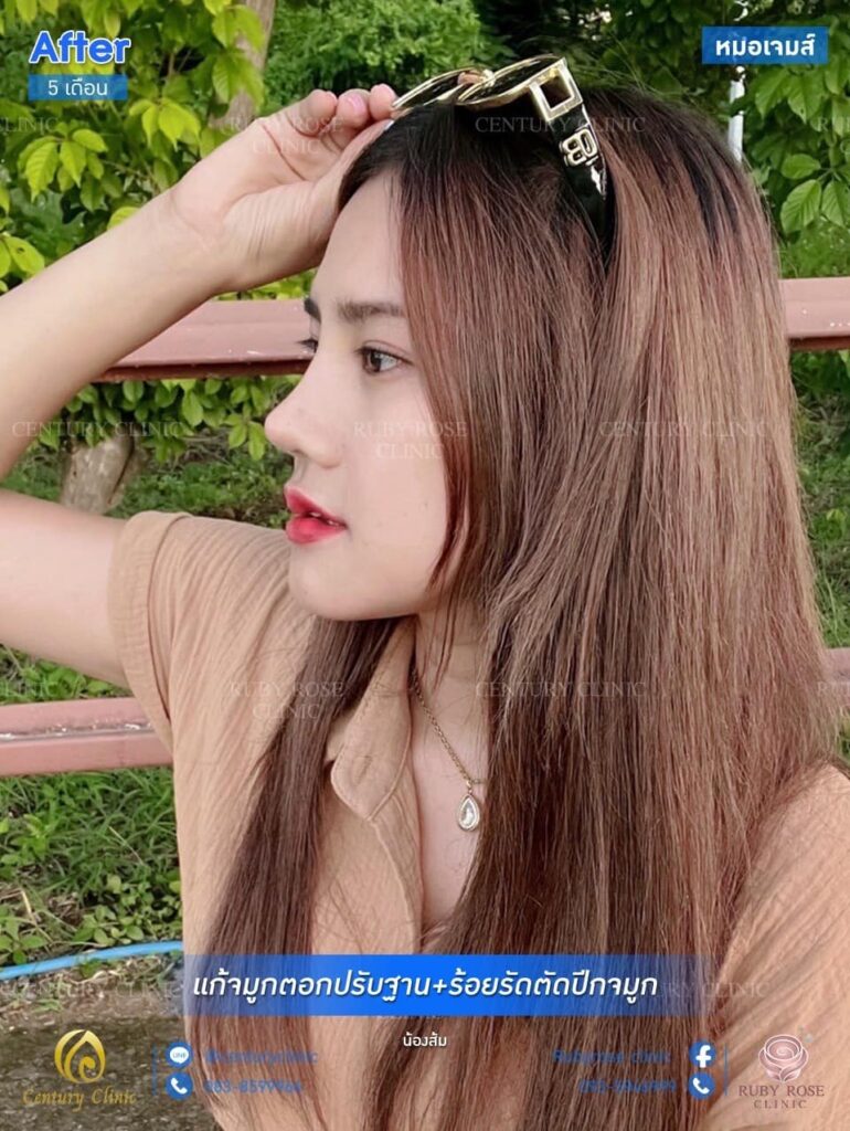 รีวิว แก้จมูก #33.1