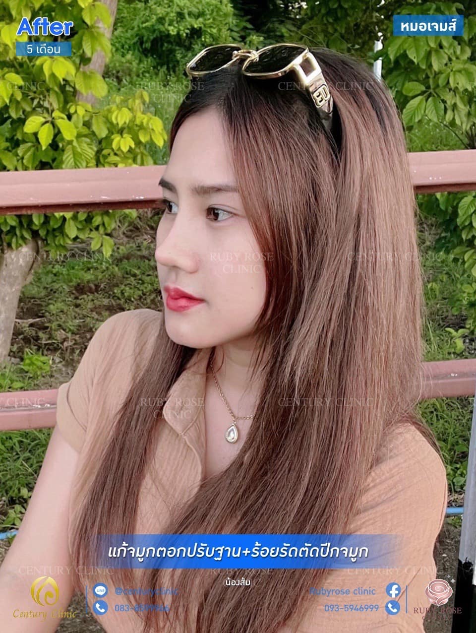 รีวิว แก้จมูก #33