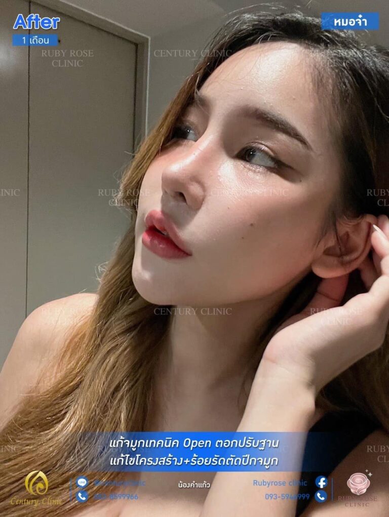 รีวิว แก้จมูก #34