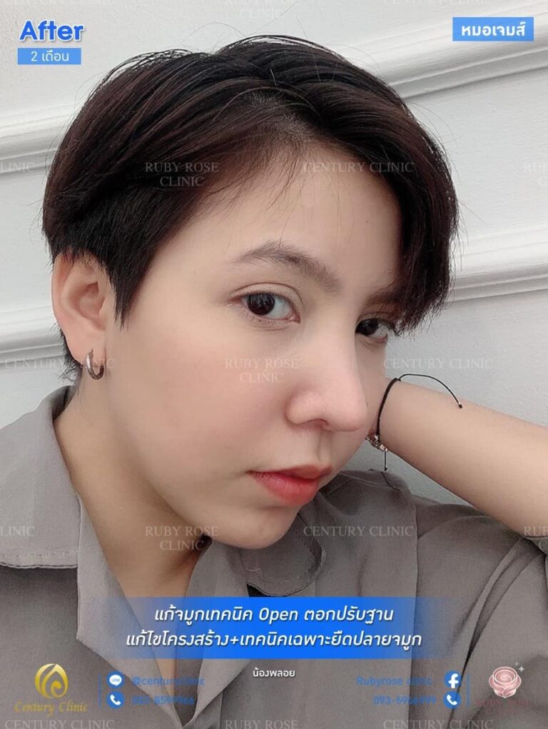 รีวิว แก้จมูก #49
