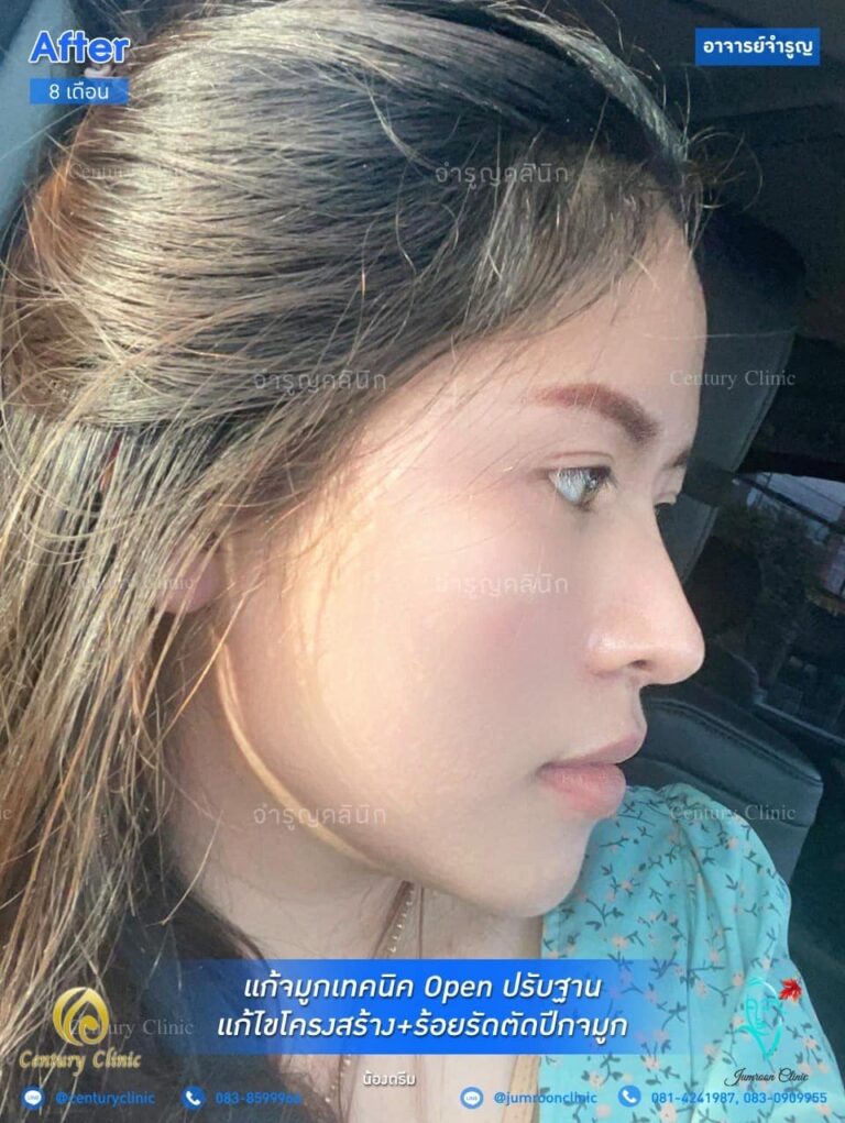 รีวิว แก้จมูก #50