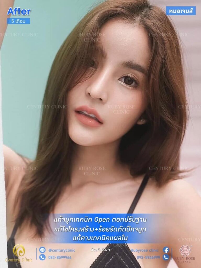รีวิว แก้จมูก #51