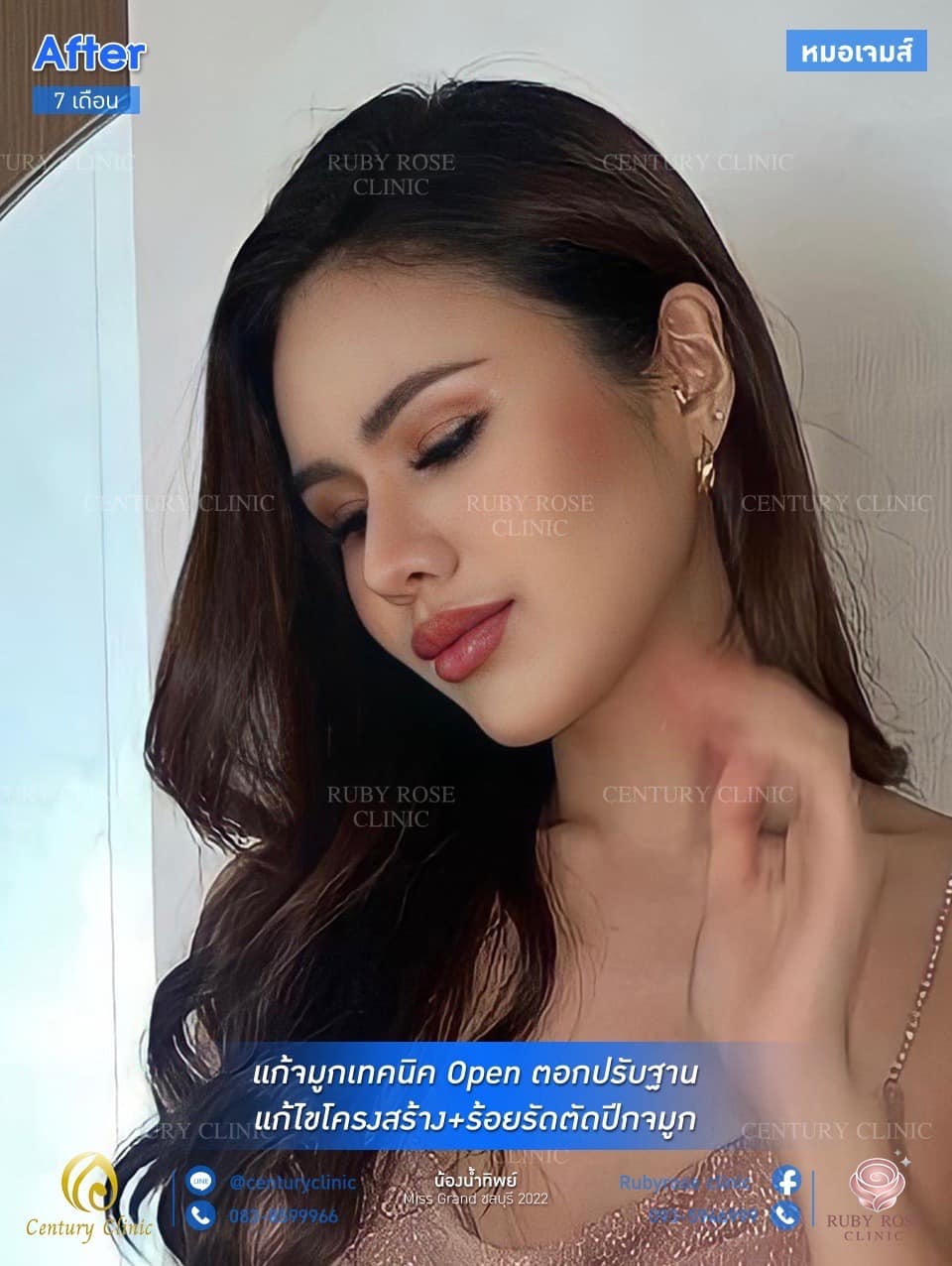 รีวิว แก้จมูก #52