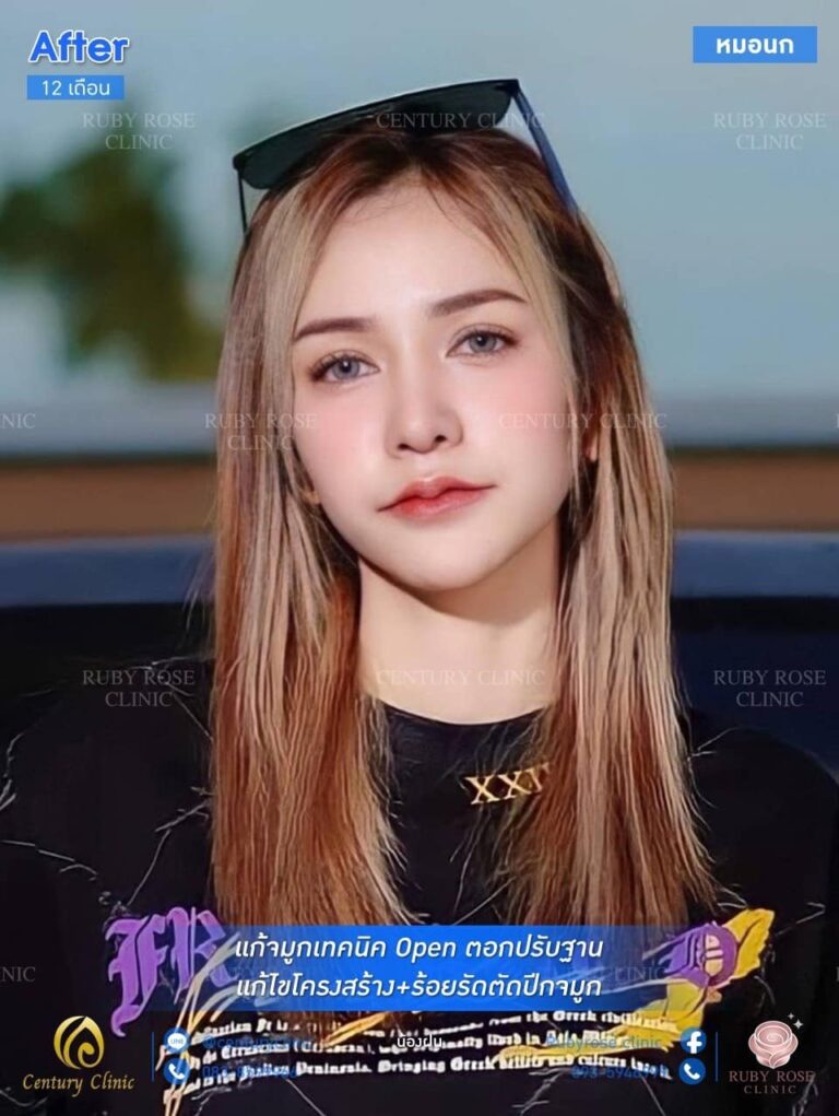 รีวิว แก้จมูก3 #53