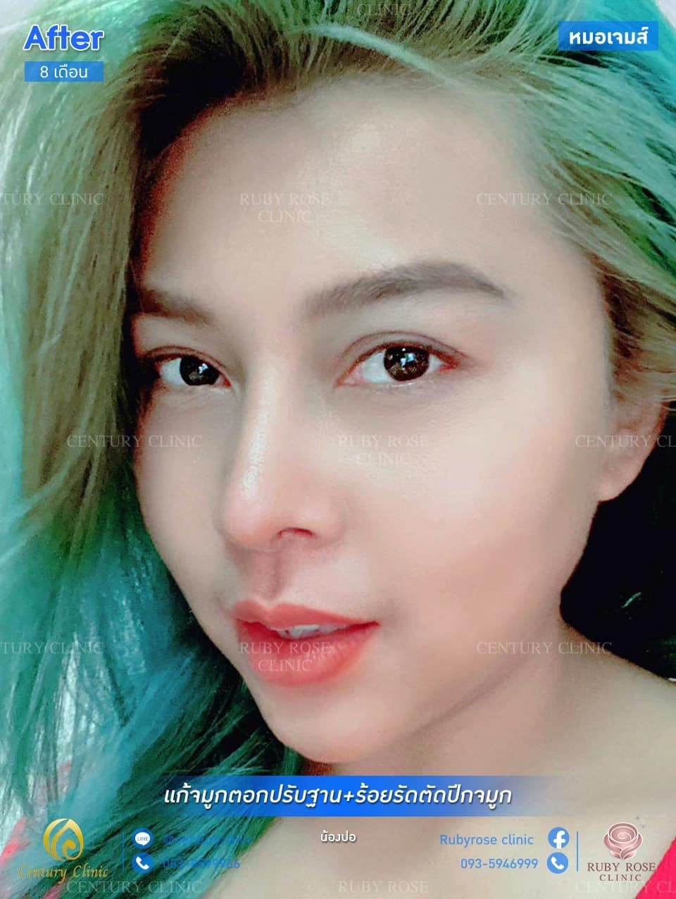 รีวิว แก้จมูก #54