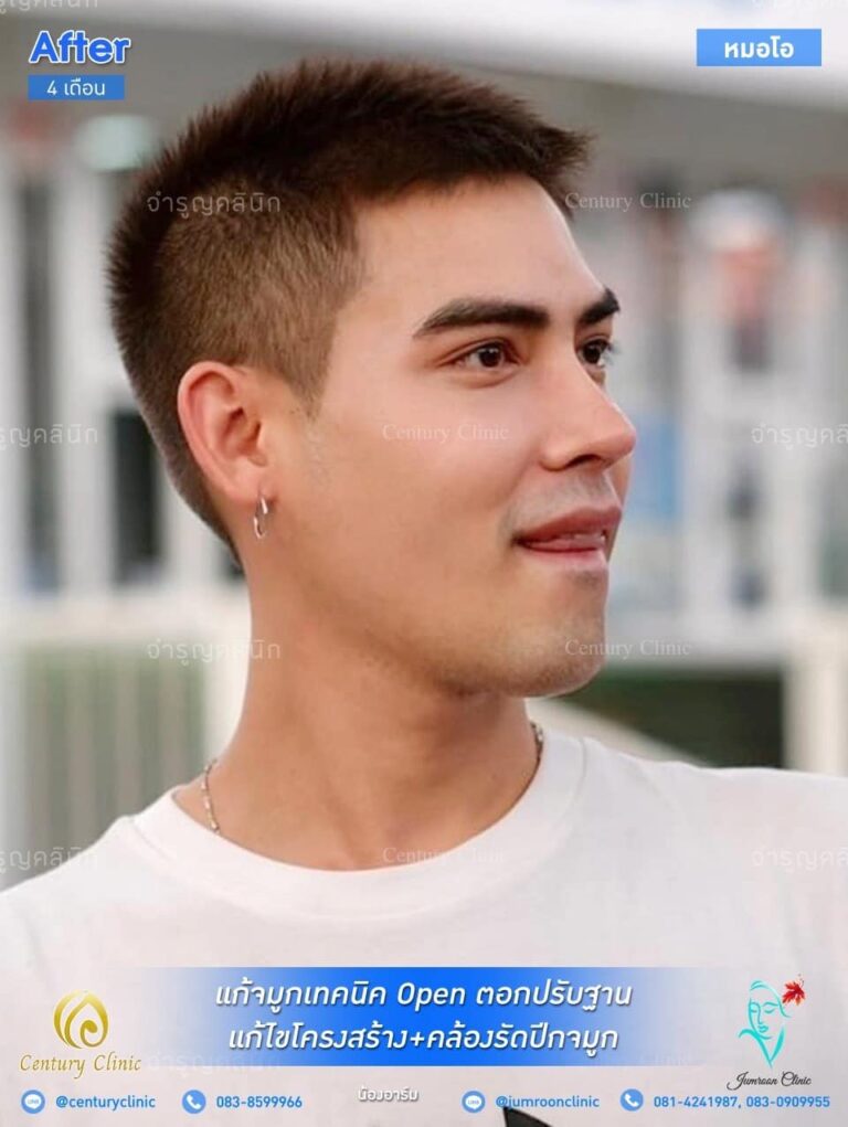 รีวิว แก้จมูก #56