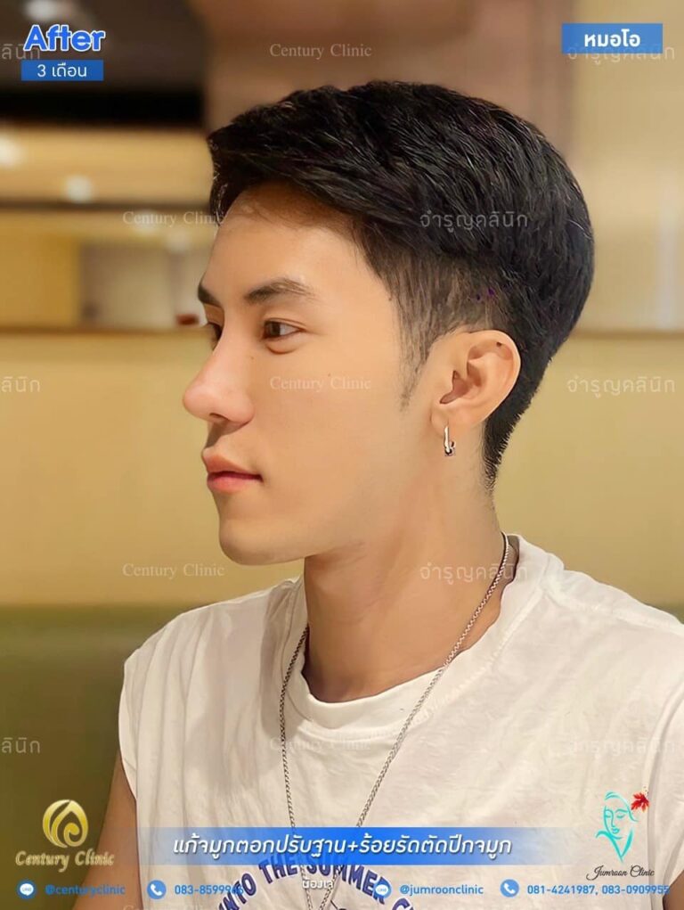 รีวิว แก้จมูก #58
