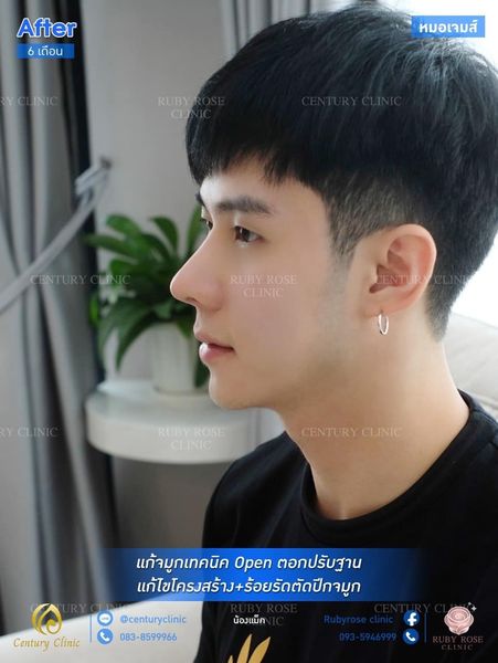 รีวิว แก้จมูก #63