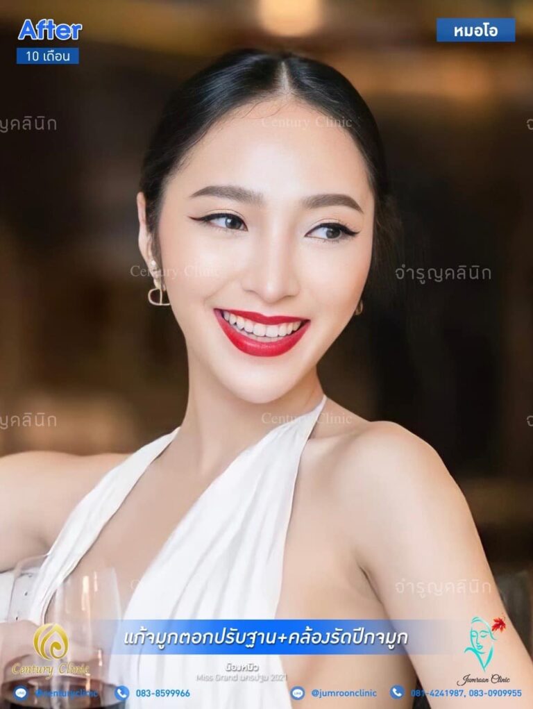 รีวิว แก้จมูก #64