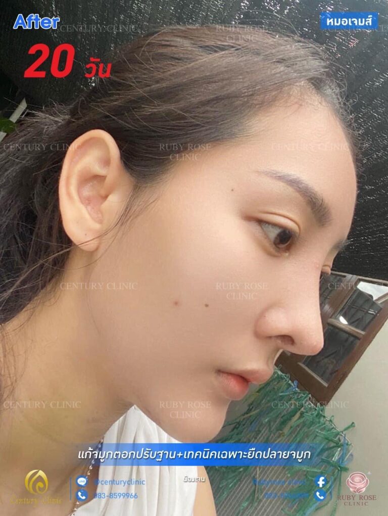 รีวิว แก้จมูก #65