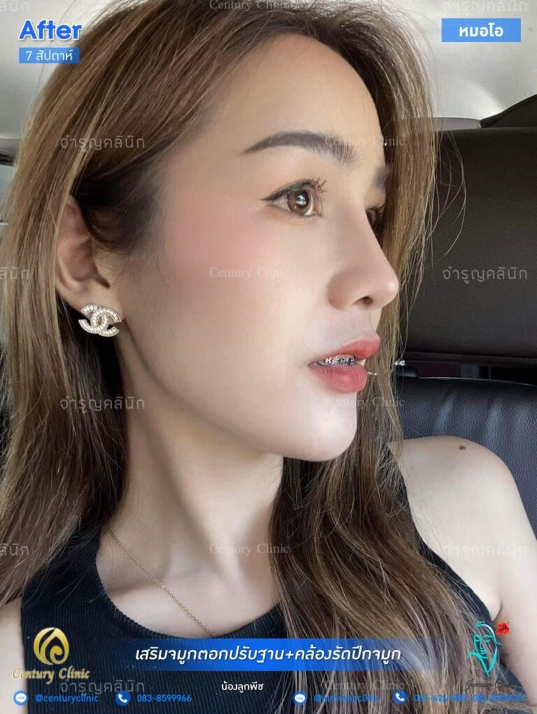 รีวิว แก้จมูก #68