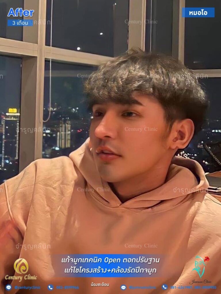 รีวิว แก้จมูก #69
