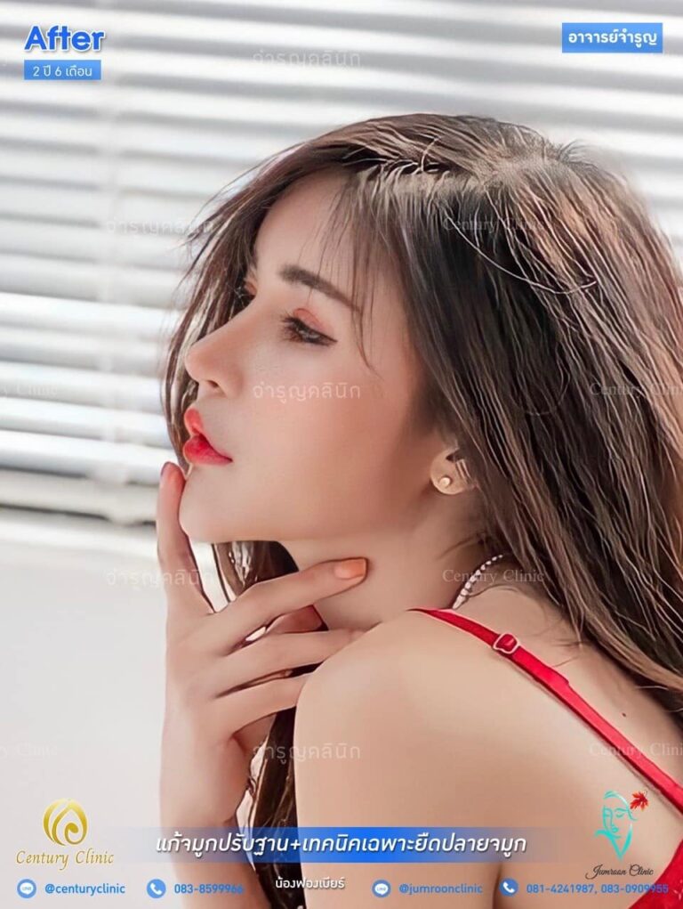 รีวิว แก้จมูก #71