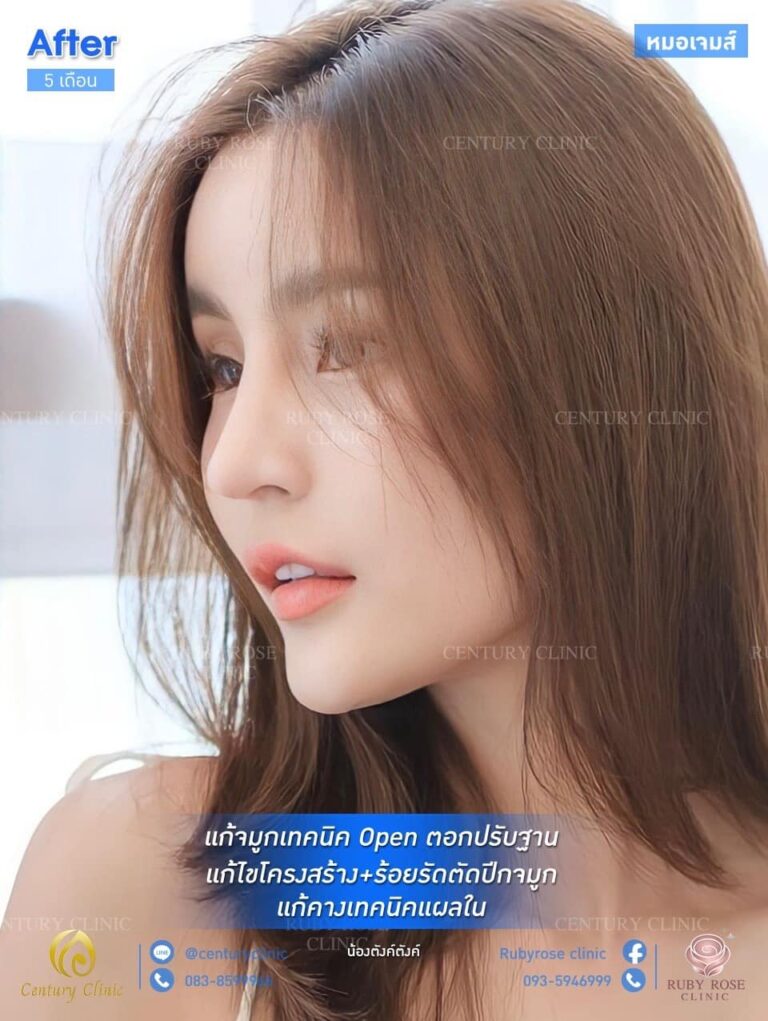 รีวิว แก้จมูก #72