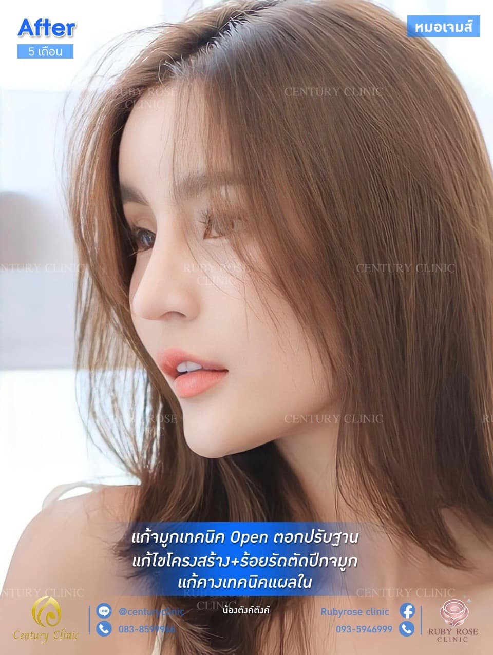 รีวิว แก้จมูก #72