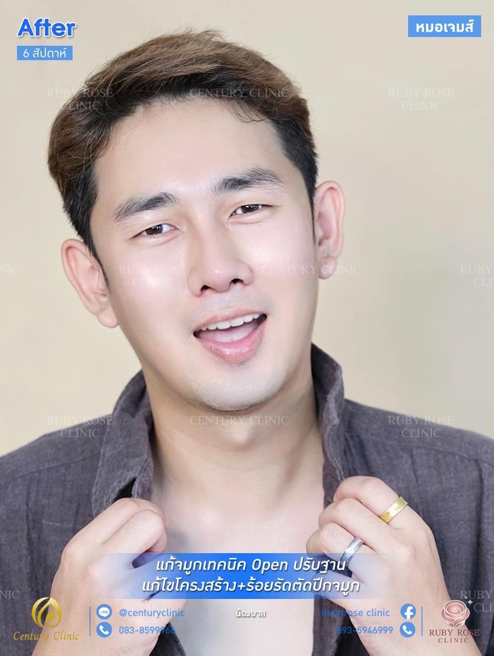 รีวิว แก้จมูก #76