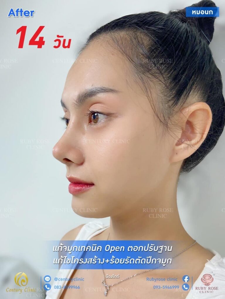 รีวิว แก้จมูก2 #81