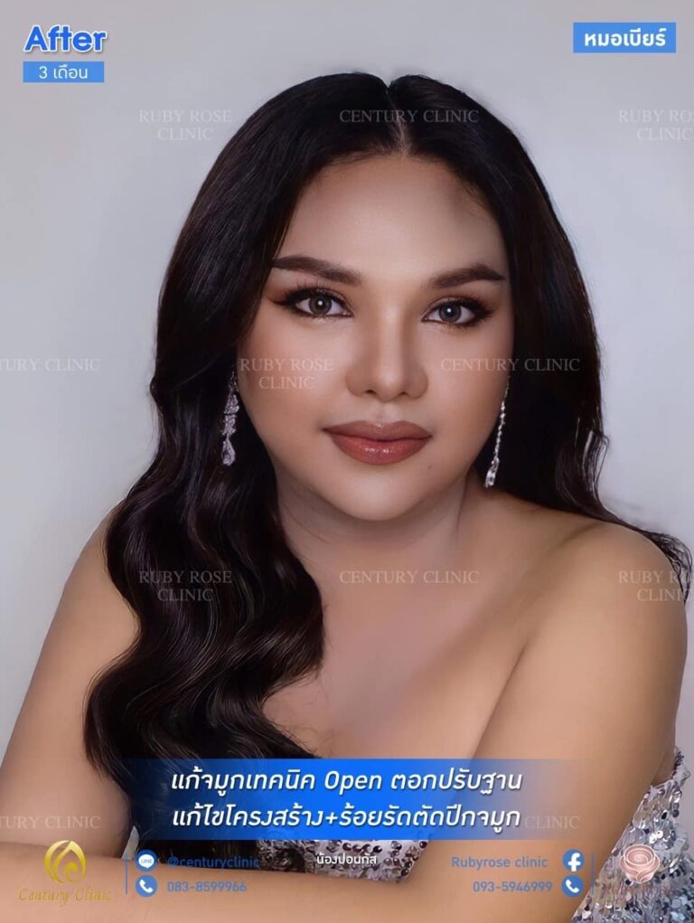 รีวิว แก้จมูก #89