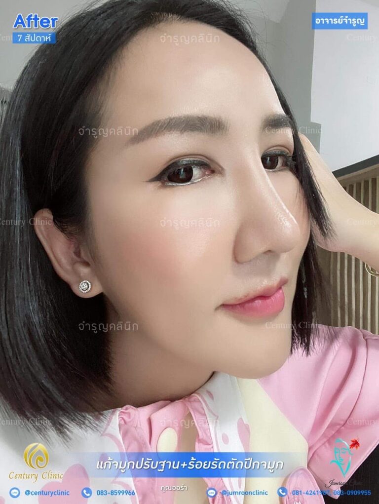 รีวิว แก้จมูก #89